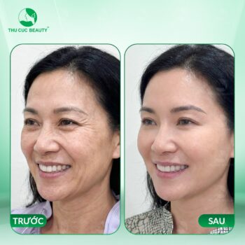 7 hiểu lầm thường gặp về tiêm botox