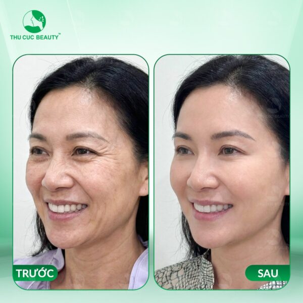 Tiêm botox xóa nhăn đuôi mắt