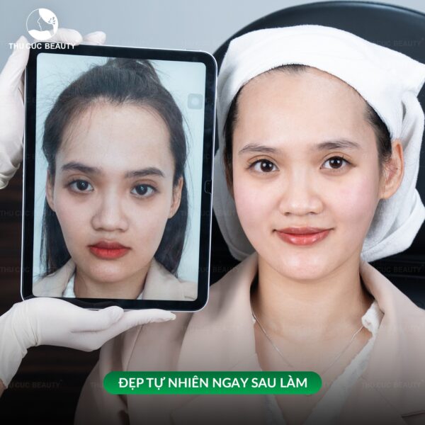 Tiêm filler khắc phục thái dương hóp