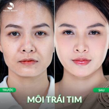 Dáng môi tiêm filler đẹp được yêu thích hiện nay