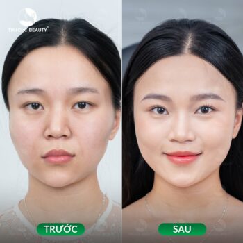 Tiêm rãnh cười sâu và những điều cần lưu ý