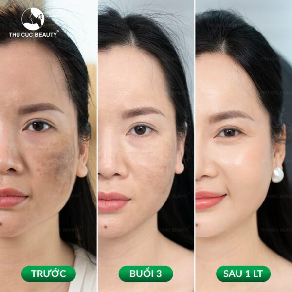 Trị nám hiệu quả sau 1 liệu trình