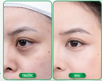 Cấy mỡ hốc mắt là gì? Những lưu ý cần biết khi cấy mỡ hốc mắt